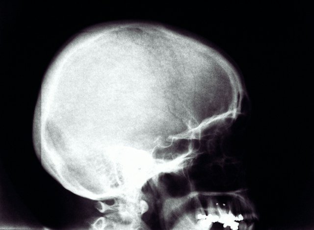 Medical illustration of a brain highlighting areas affected by traumatic brain injury after a sports-related concussion.